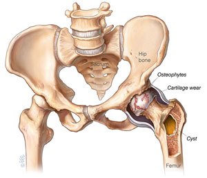 Hip Osteoarthritis