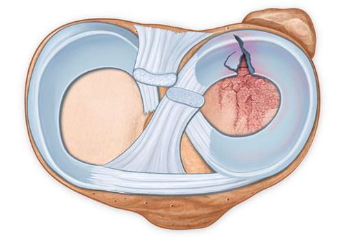 Meniscus Tear
