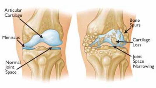 Knee osteoarthritis