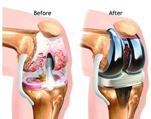 Knee osteoarthritis