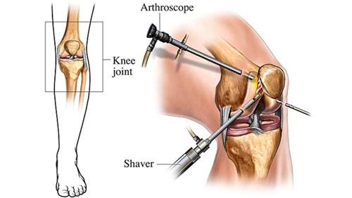 Knee osteoarthritis