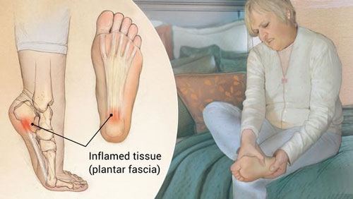Plantar Fasciitis