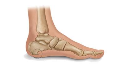 Plantar Fasciitis