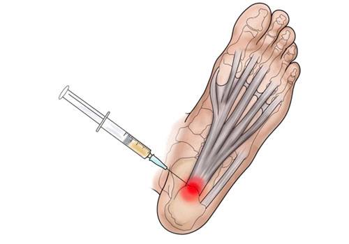 Plantar Fasciitis