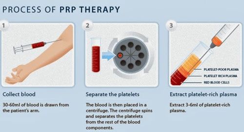 Plantar Fasciitis