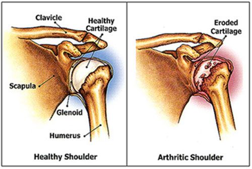 Shoulder Osteoarthritis